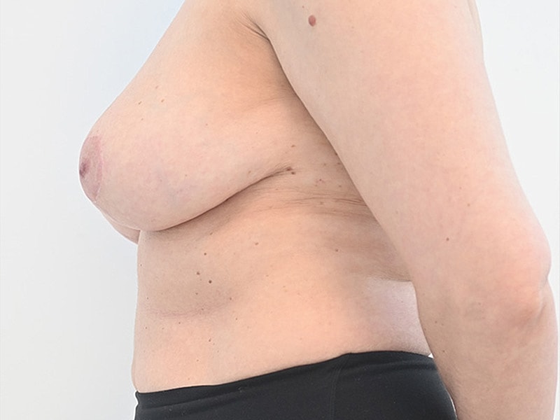 Breast Reduction with Lift Before & After