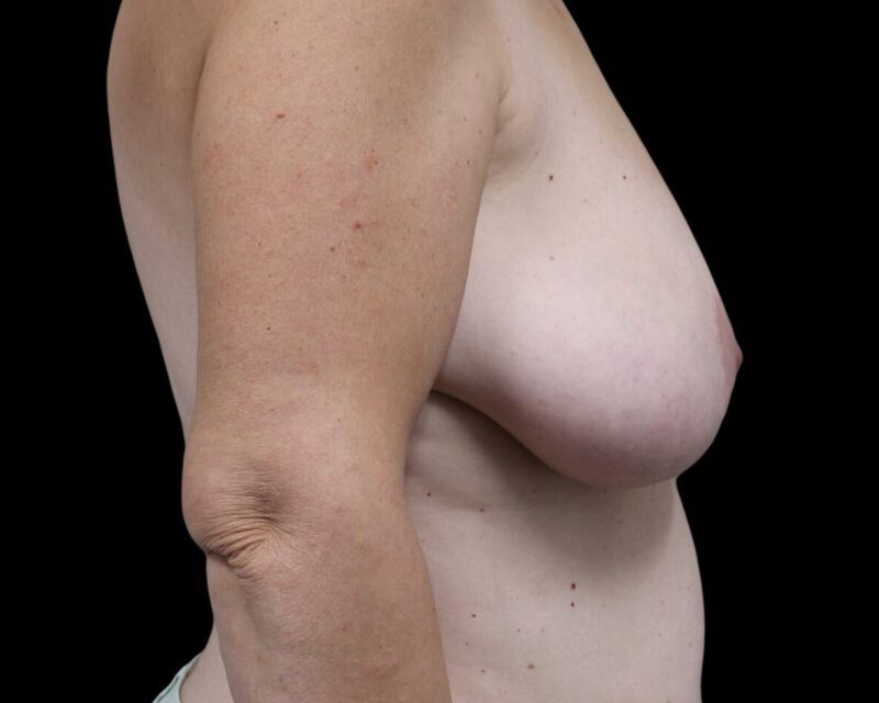 Breast Reduction with Lift Before & After