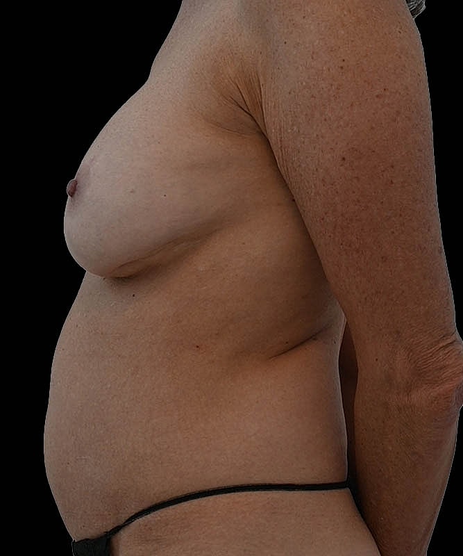 Cosmetic Flap Augmentation Before & After