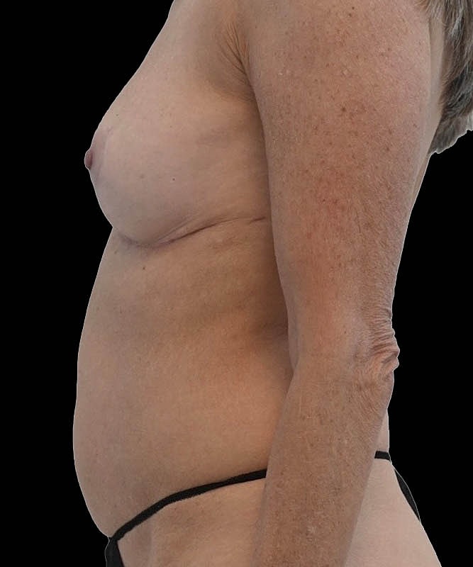 Cosmetic Flap Augmentation Before & After