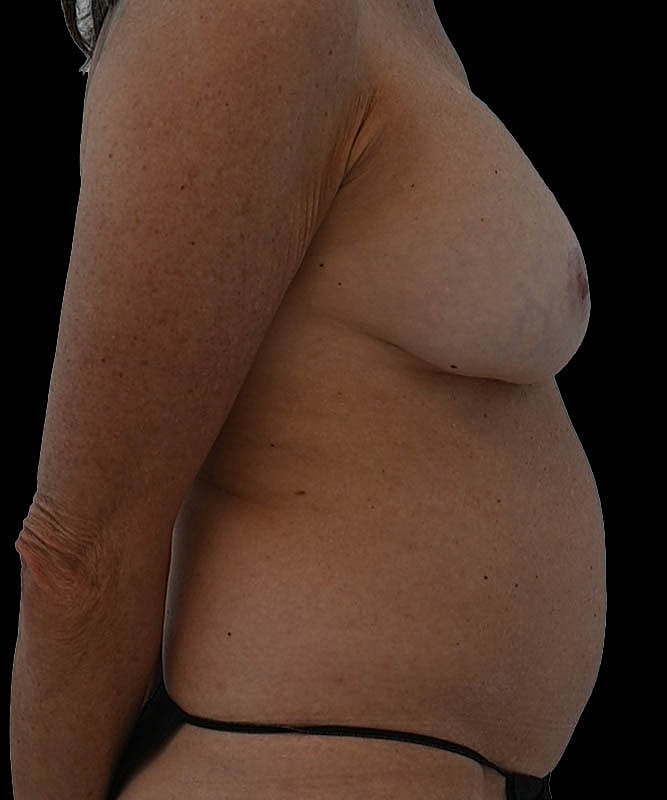 Cosmetic Flap Augmentation Before & After