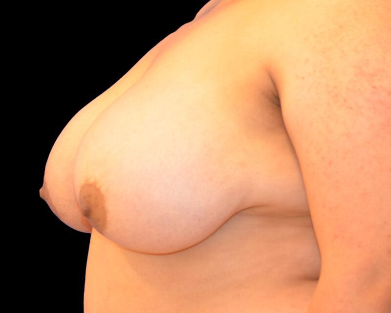 Breast Implant Before & After