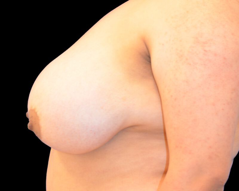 Breast Implant Before & After