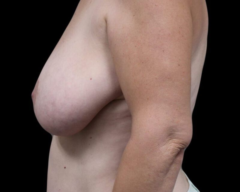 Breast Implant Before & After