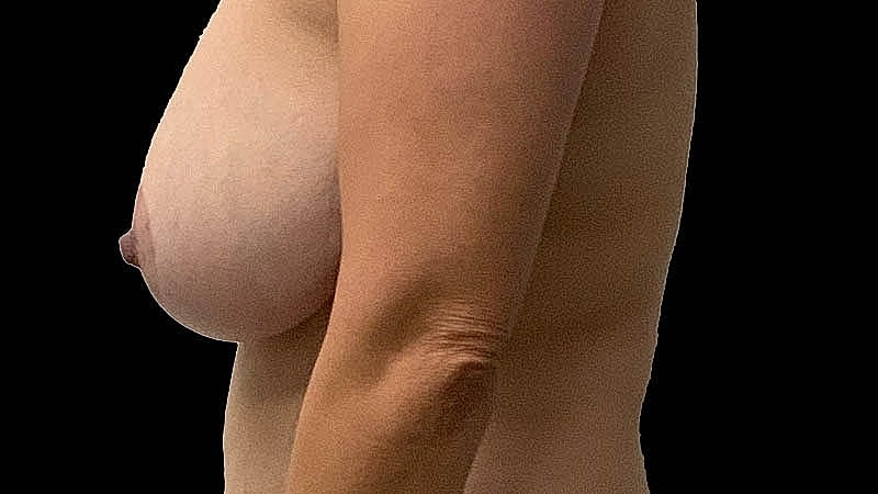 Breast Implant Before & After