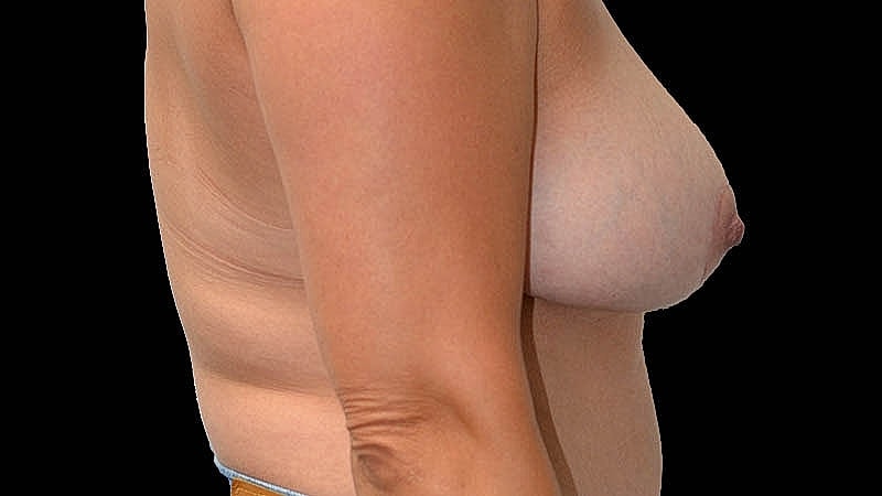 Breast Implant Before & After