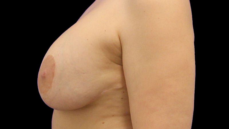 Breast Implant Removal Mastiopexy Before & After