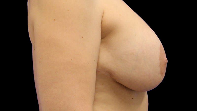 Breast Implant Removal Mastiopexy Before & After