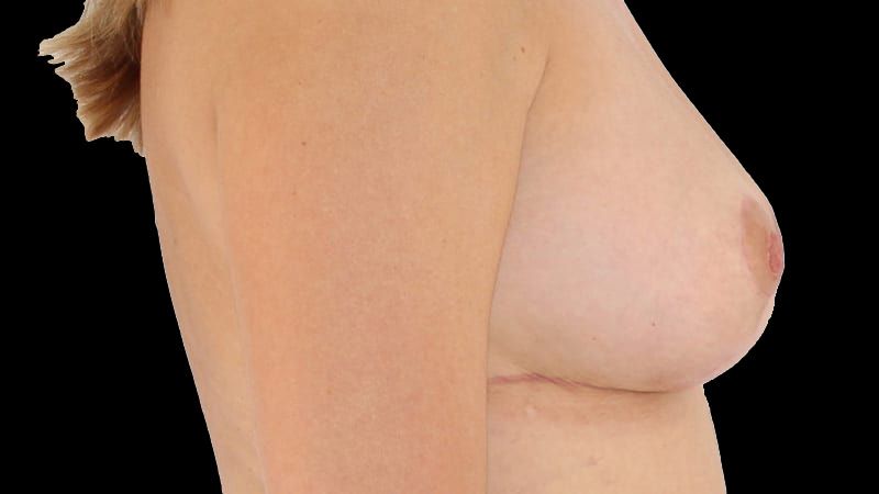Breast Implant Removal Mastiopexy Before & After