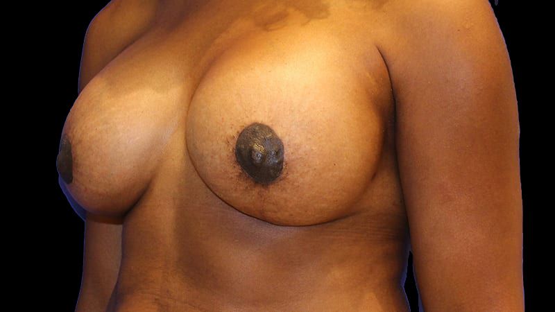 Breast Implant Removal Mastiopexy Before & After
