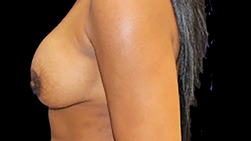 Breast Implant Removal Mastiopexy Before & After