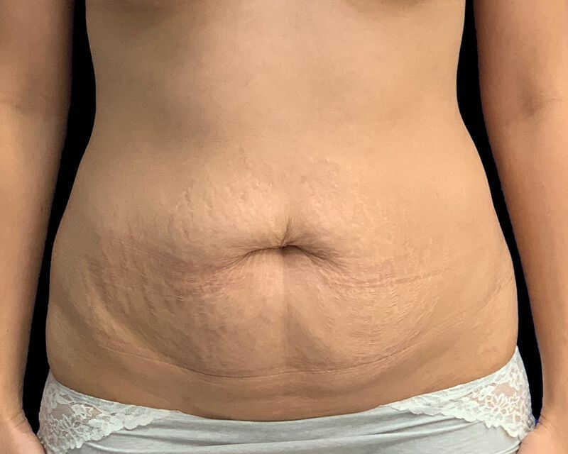Tummy Tuck Before & After