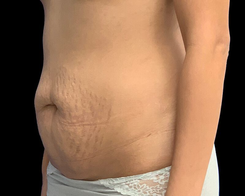 Tummy Tuck Before & After