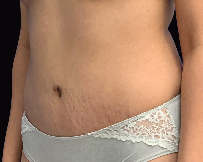 Tummy Tuck Before & After