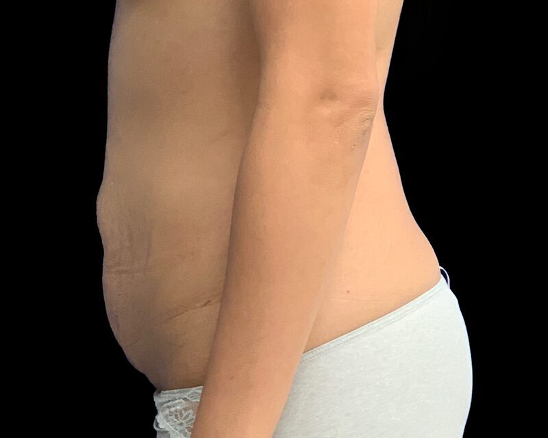 Tummy Tuck Before & After