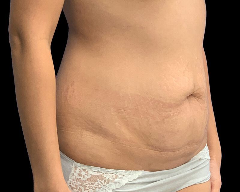 Tummy Tuck Before & After