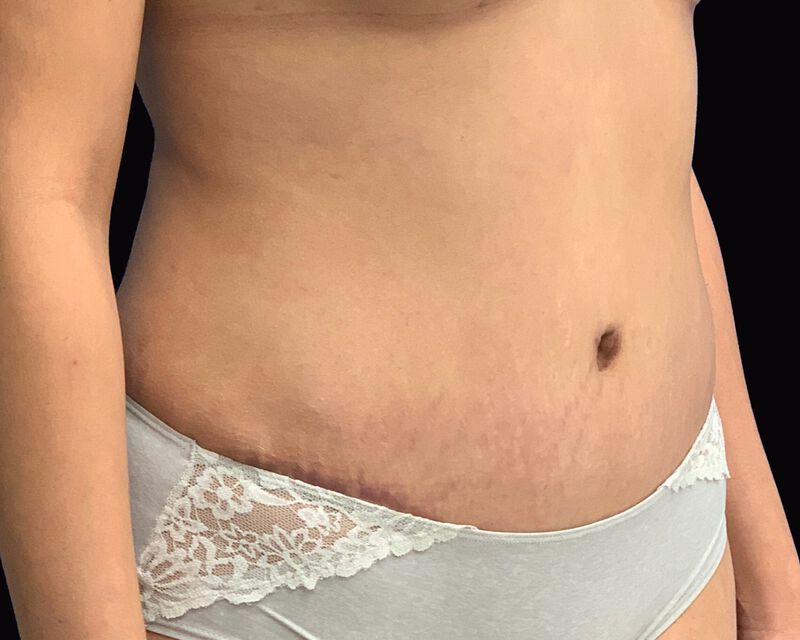 Tummy Tuck Before & After