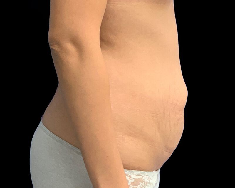 Tummy Tuck Before & After