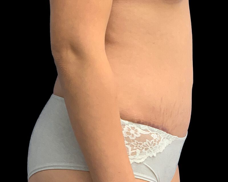 Tummy Tuck Before & After