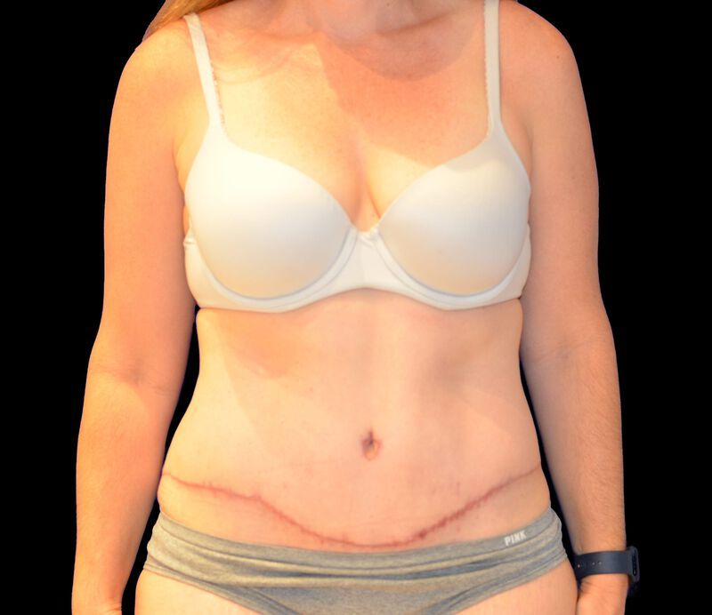 Tummy Tuck Before & After