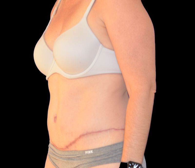 Tummy Tuck Before & After