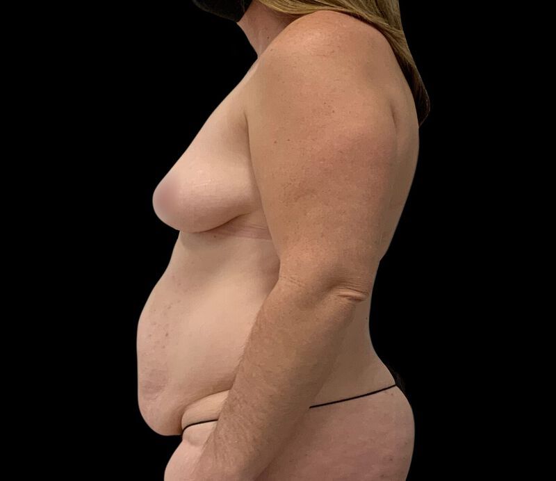 Tummy Tuck Before & After