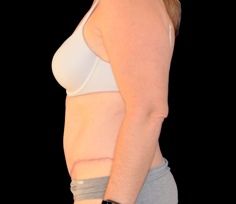 Tummy Tuck Before & After