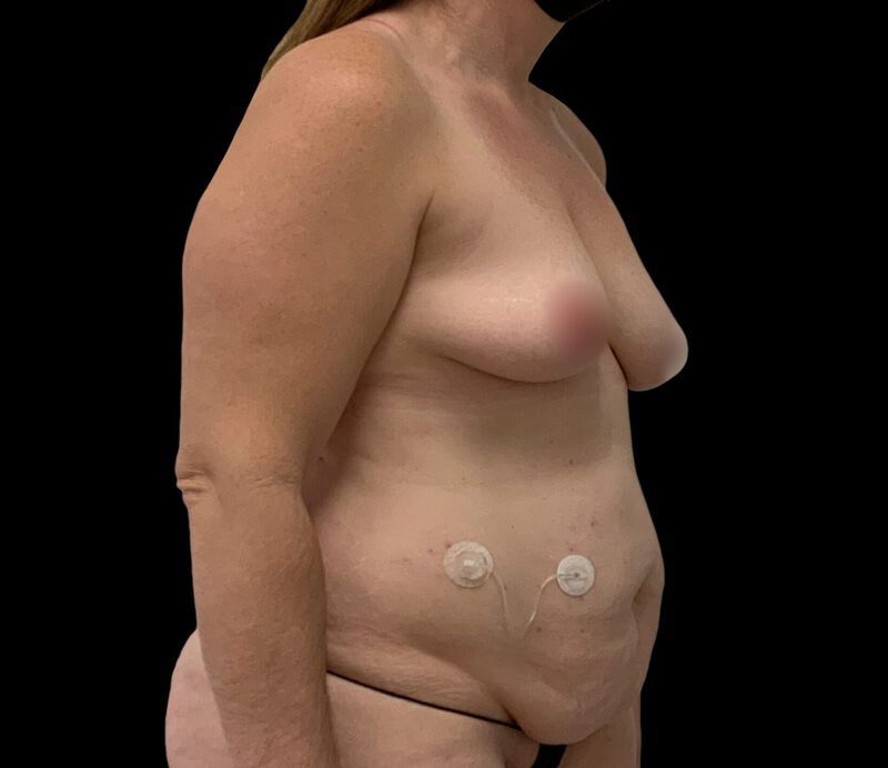 Tummy Tuck Before & After