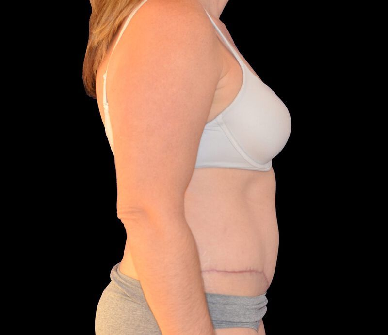 Tummy Tuck Before & After