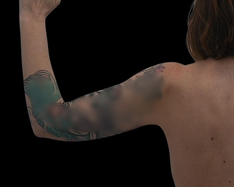 Brachioplasty Before & After