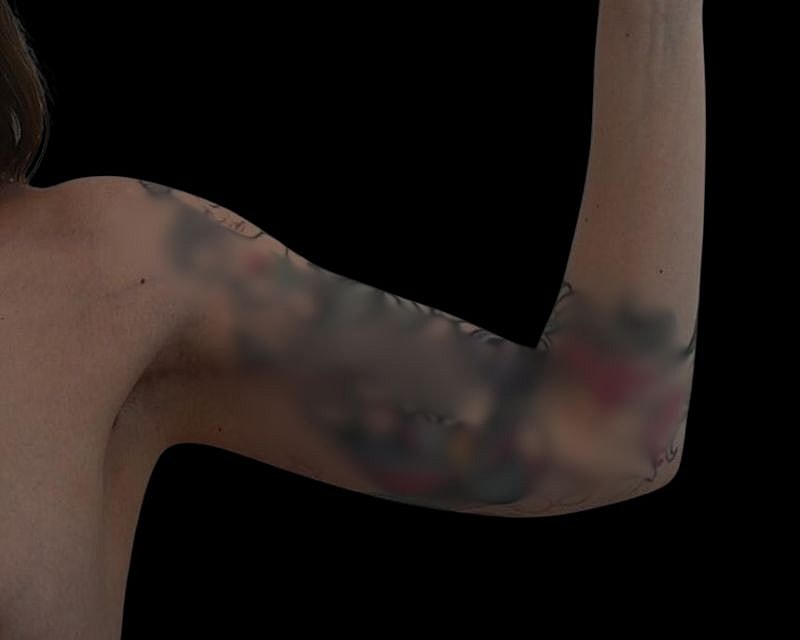 Brachioplasty Before & After