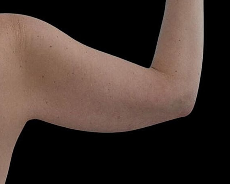 Brachioplasty Before & After