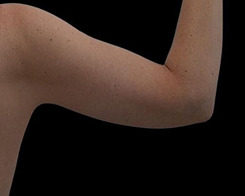 Brachioplasty Before & After