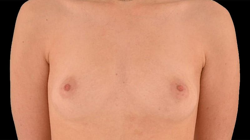 Breast Augmentation Before & After