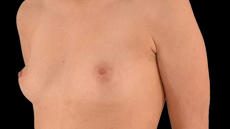 Breast Augmentation Before & After
