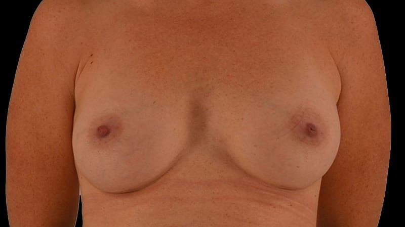Breast Augmentation Before & After