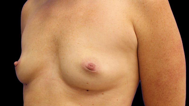 Breast Augmentation Before & After