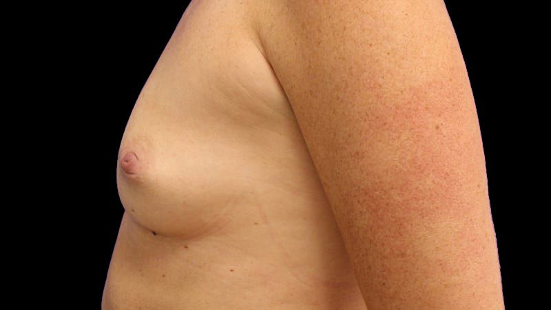 Breast Augmentation Before & After