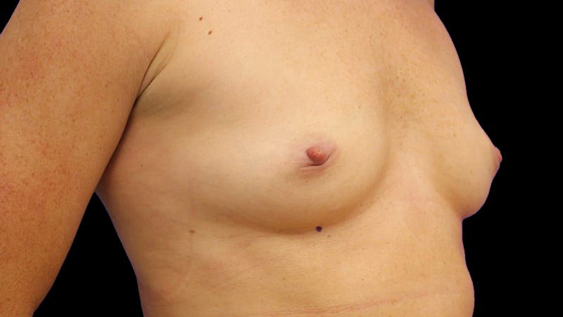 Breast Augmentation Before & After