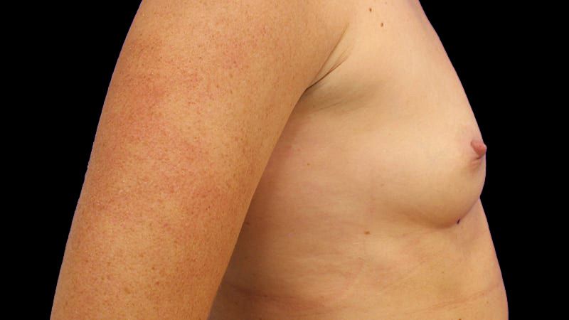 Breast Augmentation Before & After