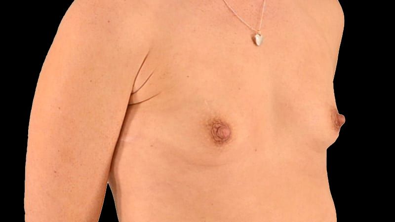 Breast Augmentation Before & After
