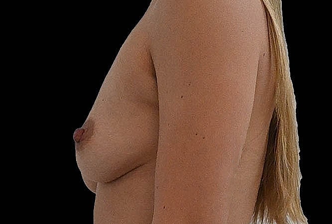 Breast Augmentation Before & After