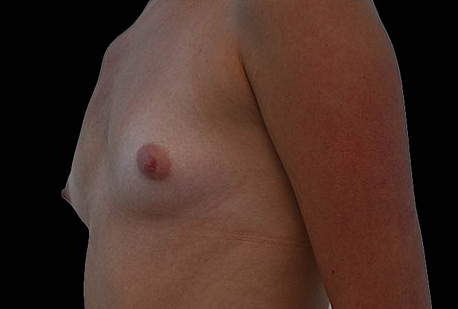 Breast Augmentation Before & After