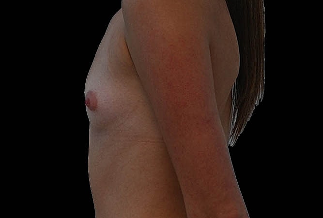 Breast Augmentation Before & After