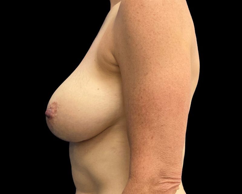 Explant With Mastopexy Before & After