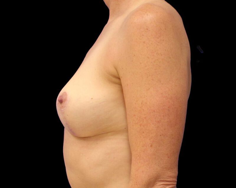 Explant With Mastopexy Before & After