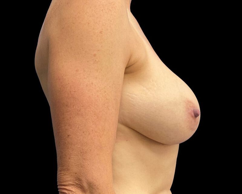 Explant With Mastopexy Before & After