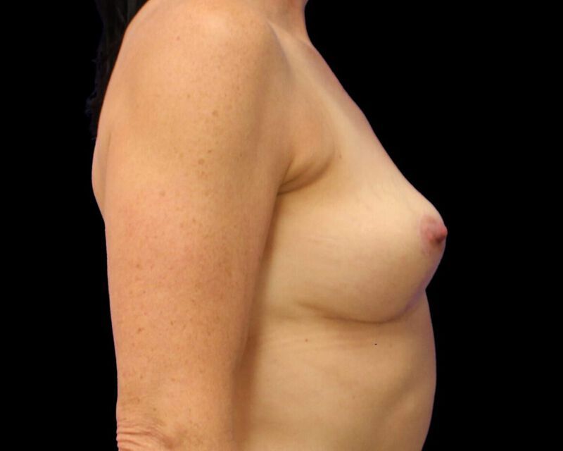 Explant With Mastopexy Before & After