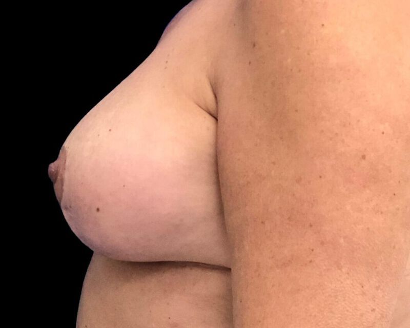 Explant With Mastopexy Before & After